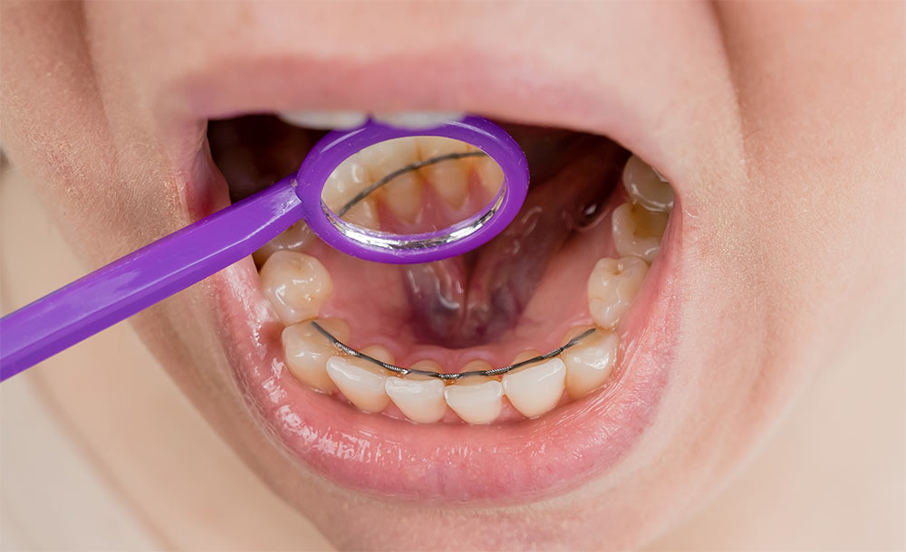 What are Orthodontic Retainers